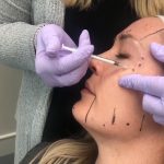 facial botox procedure