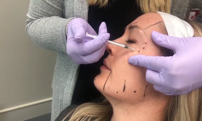 facial botox procedure