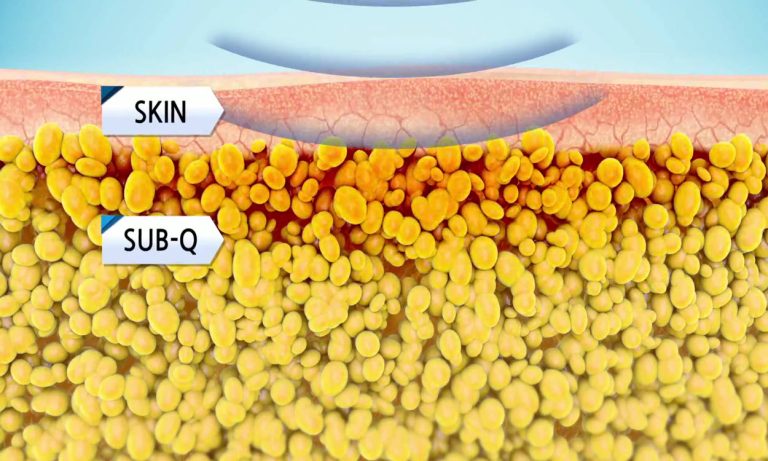 the layers of the skin and how RF energy penetrates